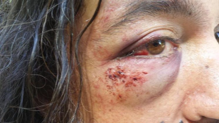 En este estado ha quedado el ojo del hombre agredido por un grupo de 15 personas en la noche de este lunes. Foto: @manutorrestv