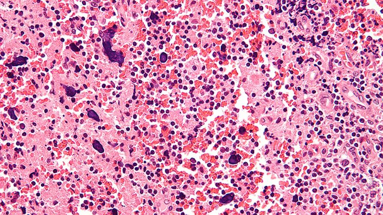 Amplificación muy alta con micrografía de los cambios histomorfológicos en un ganglio linfático debido a lupus eritematoso sistémico